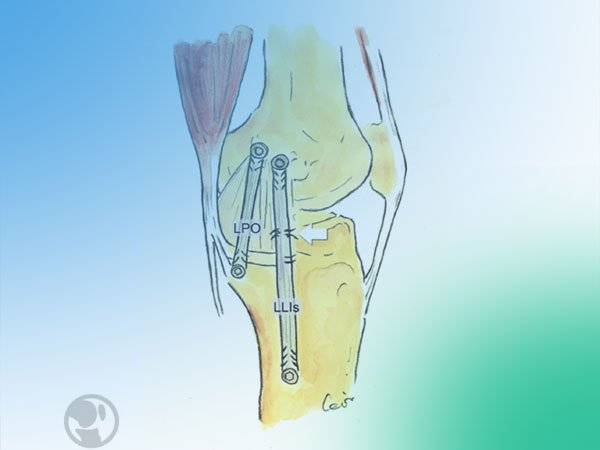 Lesiones ligamentosas mediales de la rodilla ¿Cómo tratarlas?