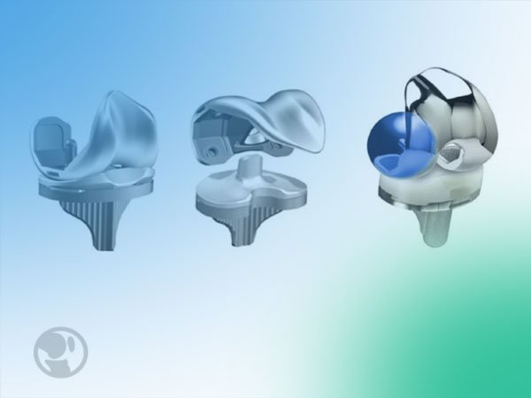 Gonartosis e implantes