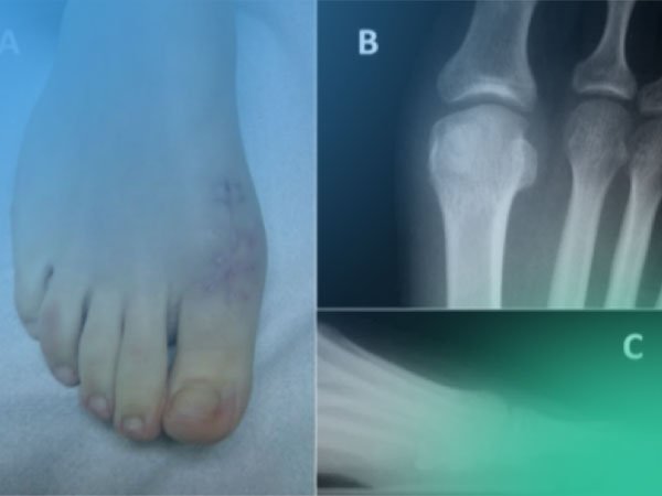 Actualización; Intra-Articular osteoma osteoide (Video).