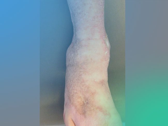 Artrodesis vs artroplastia
