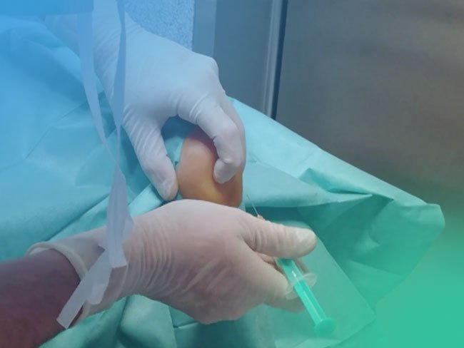 Infiltración fascia plantar.