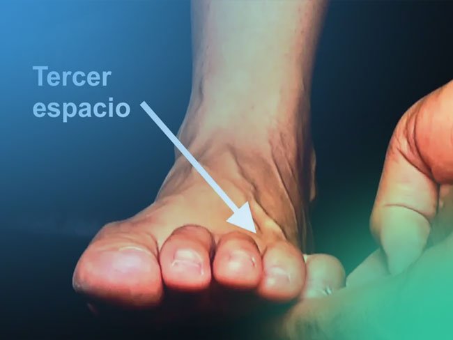 Neuroma de Morton. Descubre su exploración y el diagnóstico