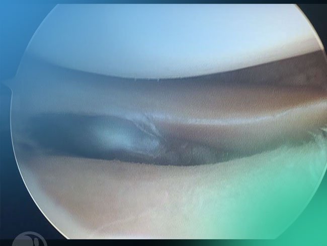 Descubre las técnicas quirúrgicas y portales mas habituales en la artroscopia de rodilla