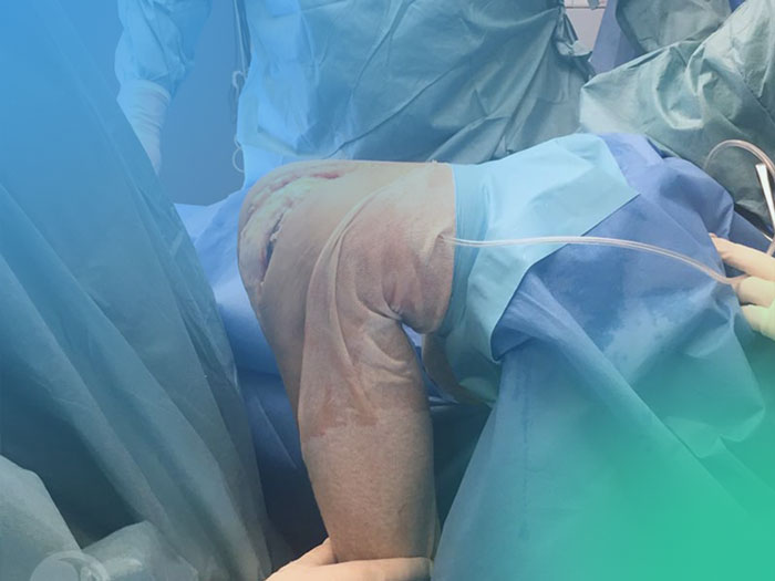 Artroplastia total de rodilla. Descubre los Criterios de infección periarticular