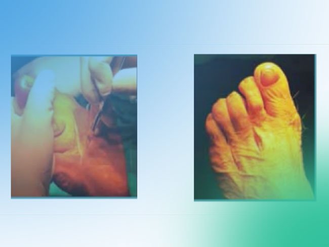 Incisión para las osteotomías de Weil: ¿una única transversal o dos longitudinales?