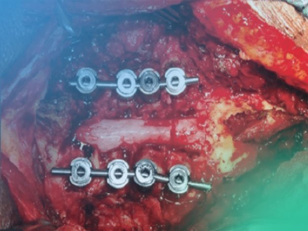 Todo lo que deseas saber del abordaje quirúrgico de la columna cervical