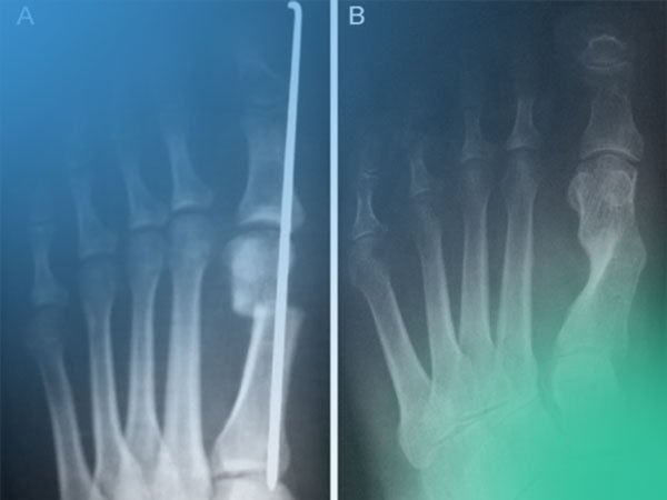 Video revisión artículo; comparación del coste postoperatorio Hallux Valgus, Kramer vs Scarf
