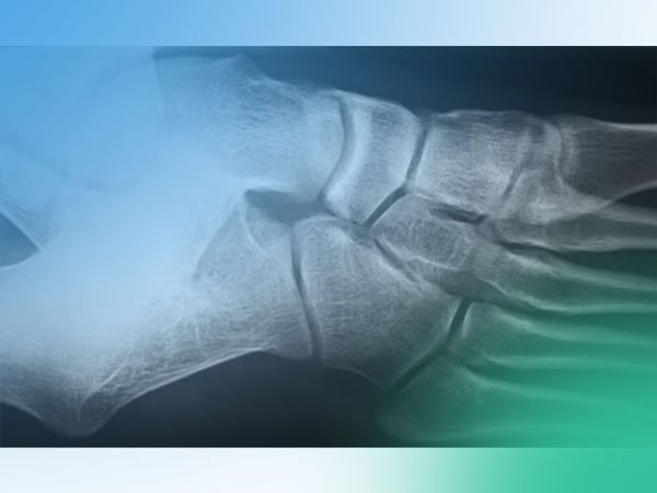 Video revisión de artículo: Perforaciones retrogradas en lesiones osteocondrales en la cabeza del astrágalo