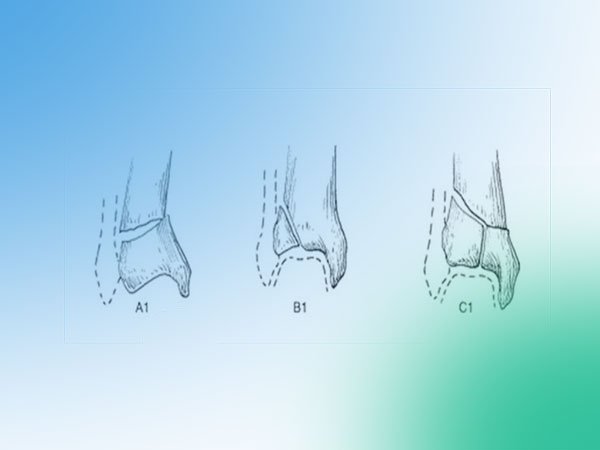 Fracturas del pilón tibial