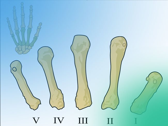 Ventajas y desventajas de la Artroplastia Trapecio-Metacarpiana