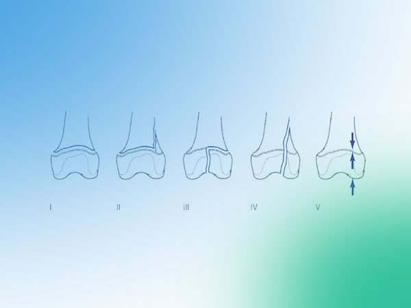 Descubre las fracturas fisarias de la rodilla pediátrica