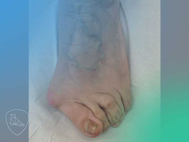 Descubre la patofisiología del pie reumático