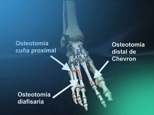 Conoce las diferentes osteotomías de ascenso proximal en las metatarsalgias tipo Rocker II (estáticas)