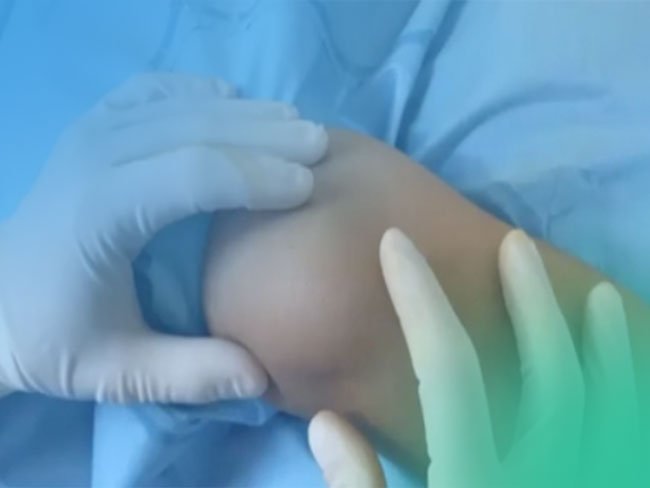 Descubre los tipos de inestabilidad patelofemoral en pacientes en crecimiento