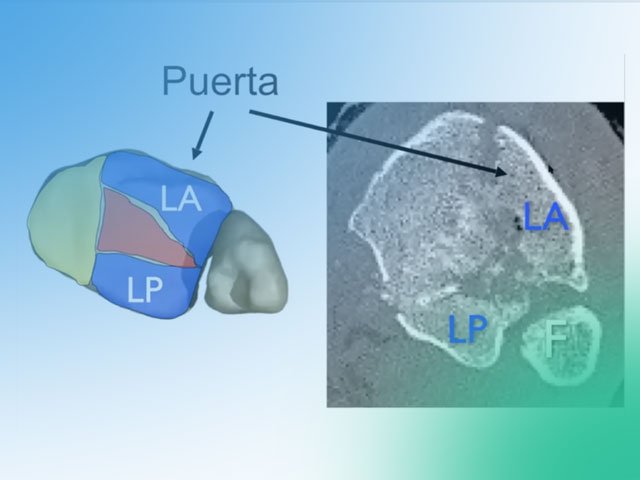 Clasificación y abordajes de las fracturas de pilón tibial