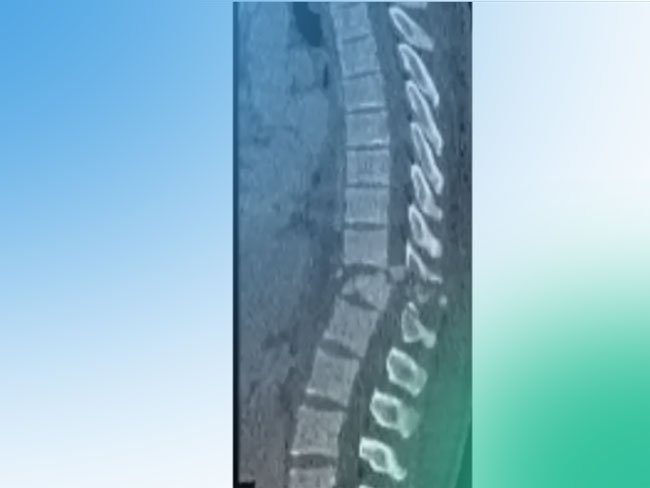 Descubre la clasificación de las fracturas vertebrales tóraco-lumbares